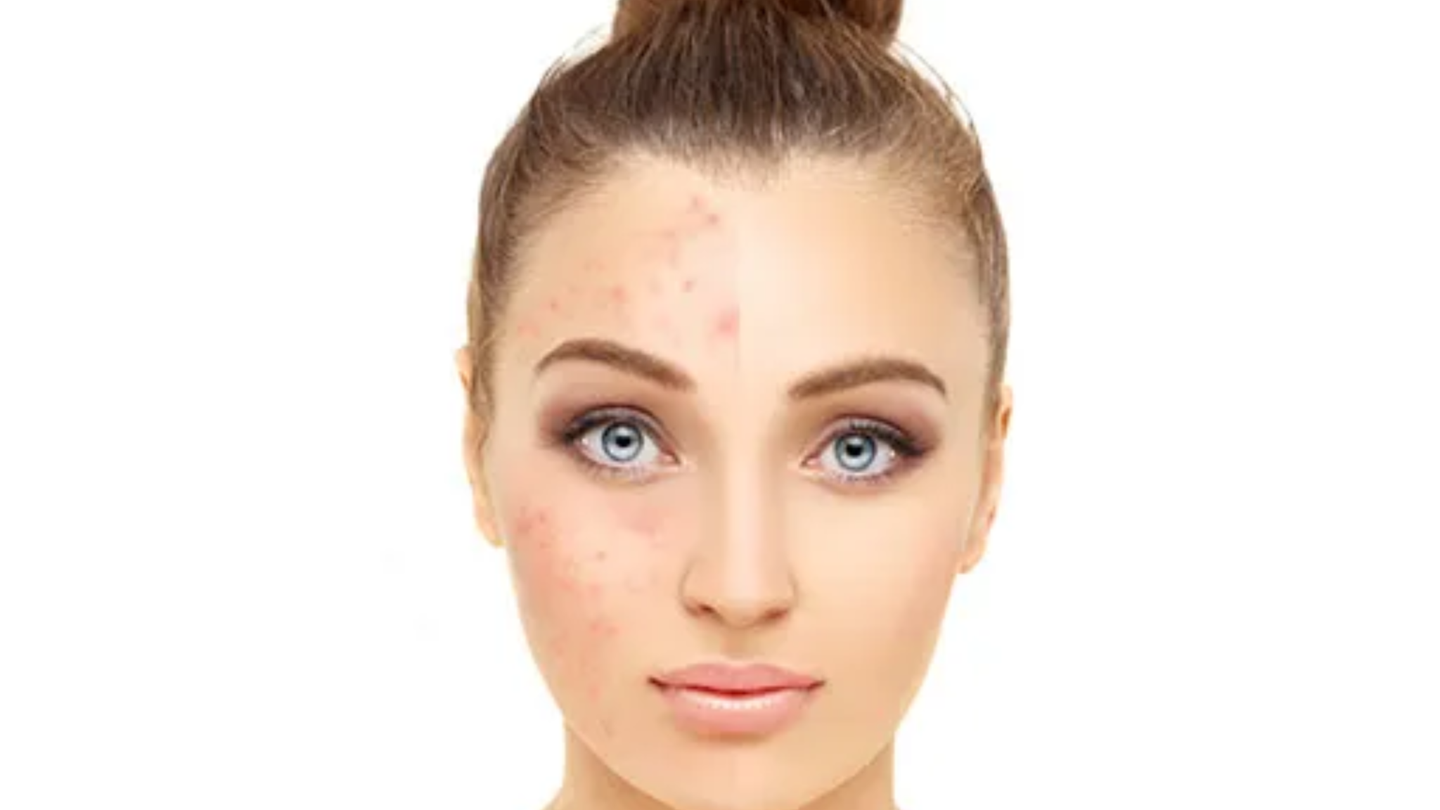 understanding-melasma-causes-treatments-and-home-remedies